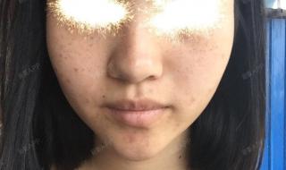 医院可以点斑吗 医院点斑多少钱